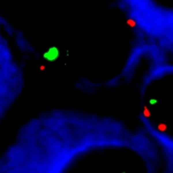 Magnified and coloured image of cells for Leukaemia talk